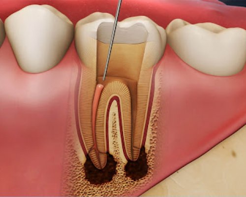 Endodontics